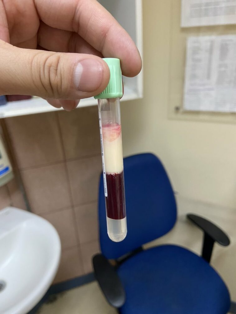Sangre De Un Paciente Con 9000 Mgdl De Triglicéridos 4483